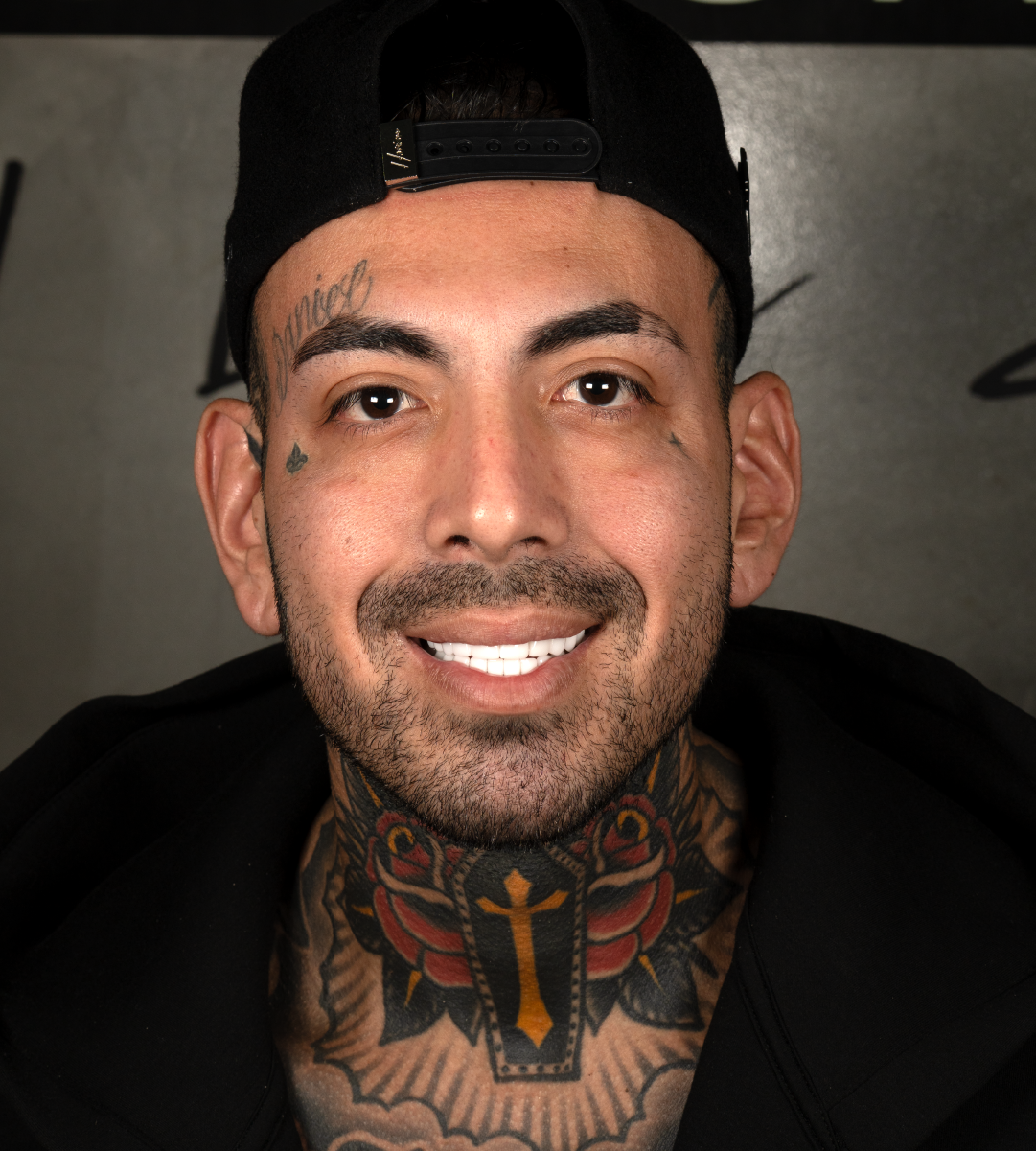 Full-mouth-rehabilitation 1a