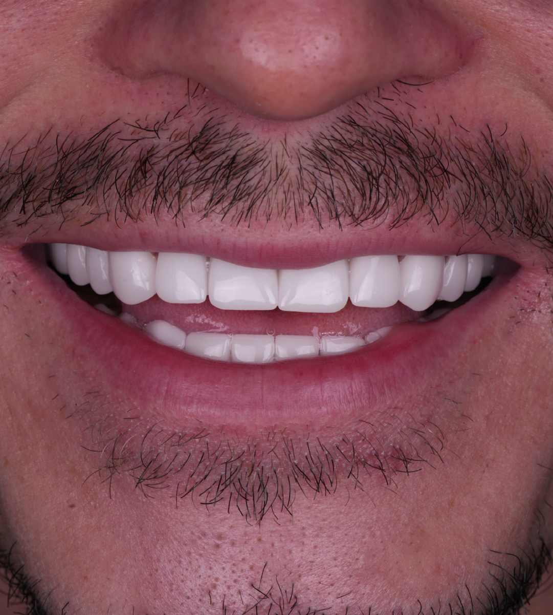 Full-mouth-rehabilitation 1a.webp