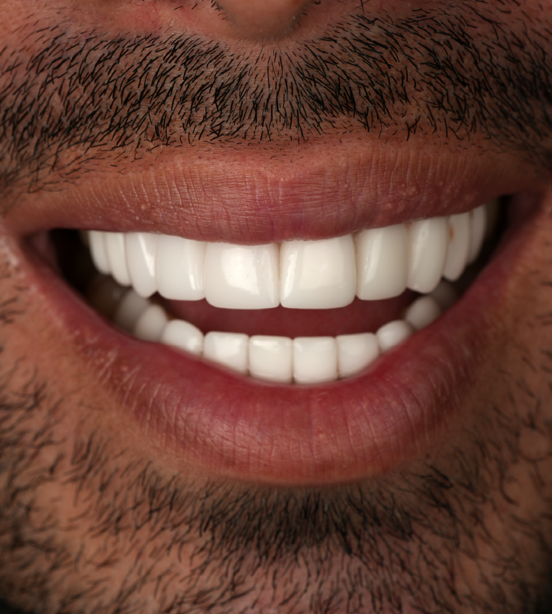 Full-mouth-rehabilitation 1b