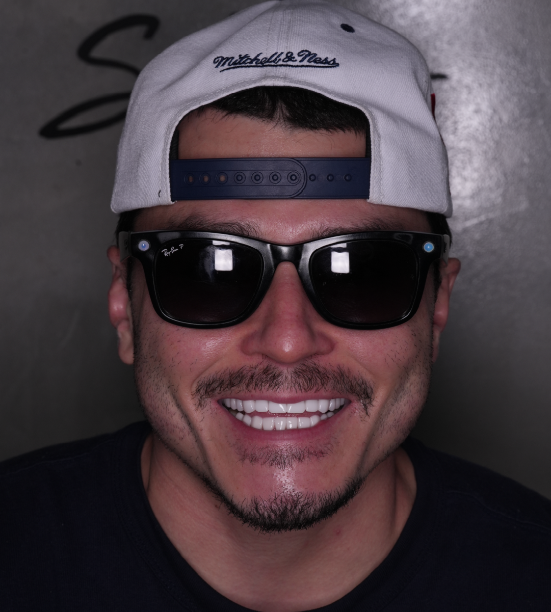 Full-mouth-rehabilitation 1cwebp