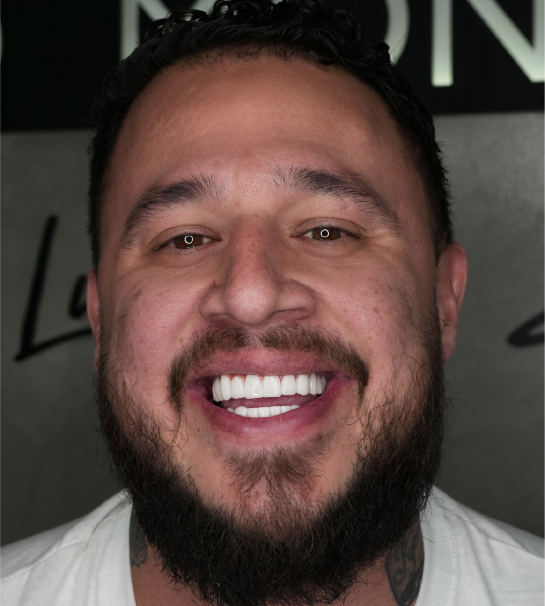 Full-Mouth Rehabilitation in Atlanta Dr Mario Montoya Slider 3