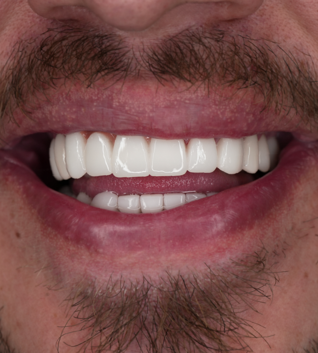 Full-Mouth Rehabilitation in Atlanta Dr Mario Montoya Slider 4